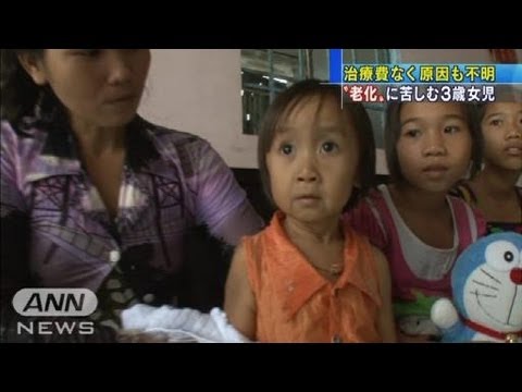 原因不明・・・3歳少女が老婆に？生後4カ月で顔にしわ（12/10/02）