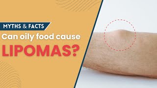 Lipoma Myth: Can Oily food cause lipomas? | Lipoma Treatment in Delhi | Lipoma Surgery in Delhi
