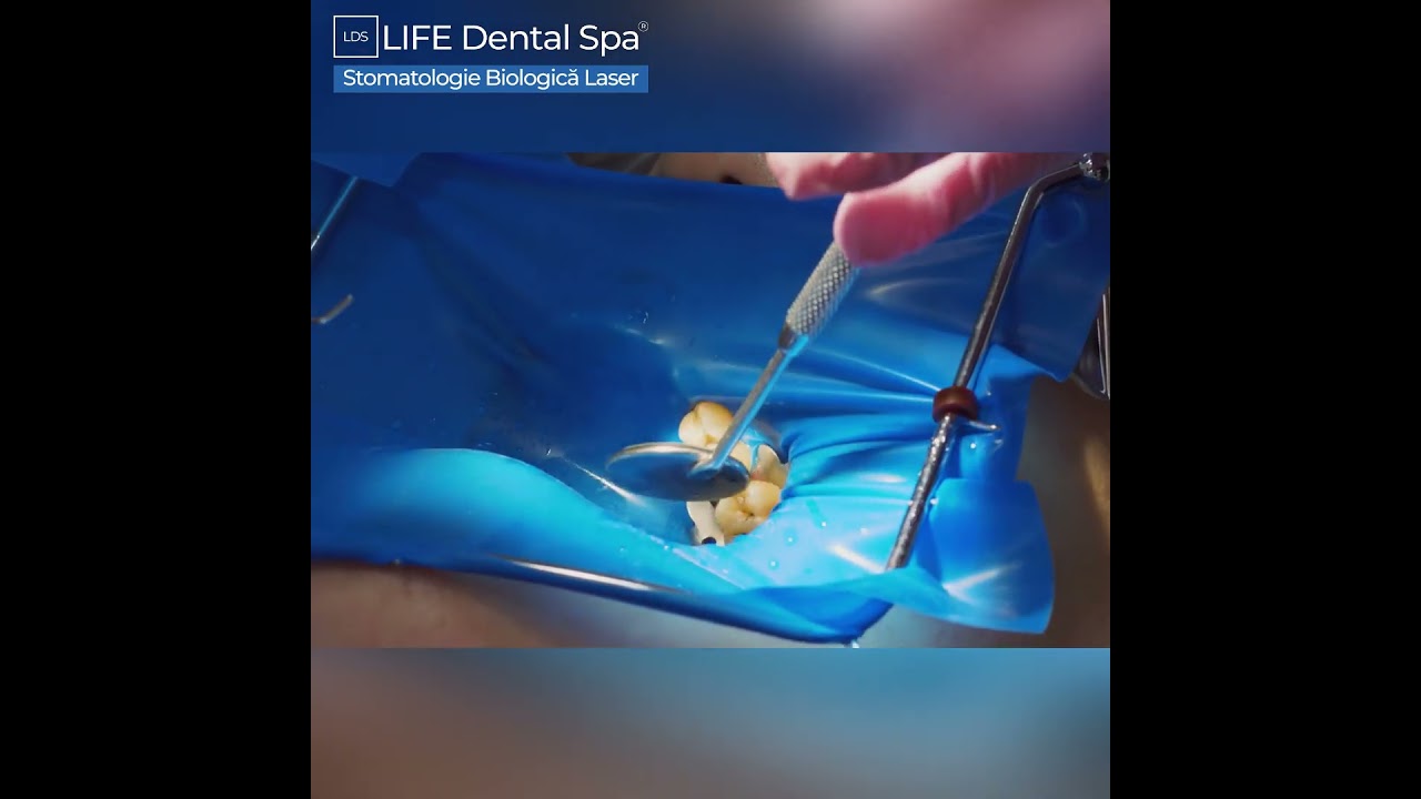 Tratament carii cu laser - aplicare plombă