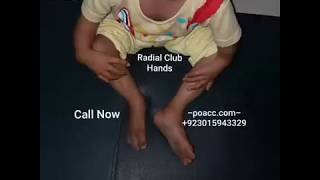 Radial Club Hands At Pakistan Orthopedic And Cosmetology Center