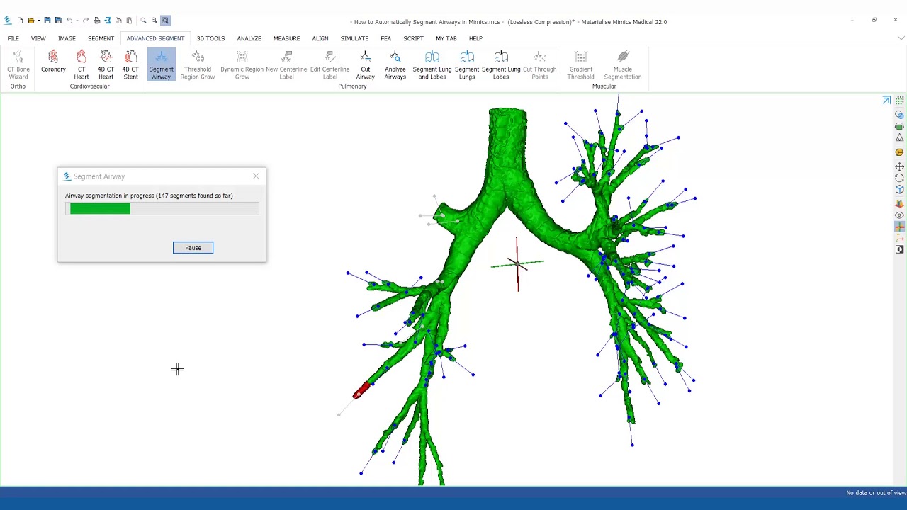 How to automatically segment airways in Mimics?