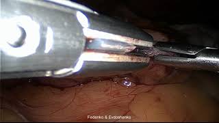 Bipolar Hemostasis Of The Staple Line
