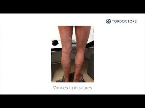 ¿Qué son las varices?