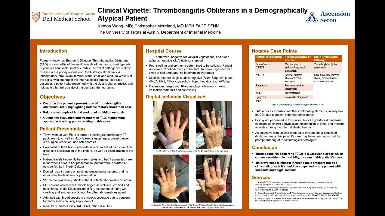 Thromboangiitis Obliterans TX ACP 2023 Clinical Narration