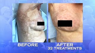 See Burn Victim’s Transformation after Treatment