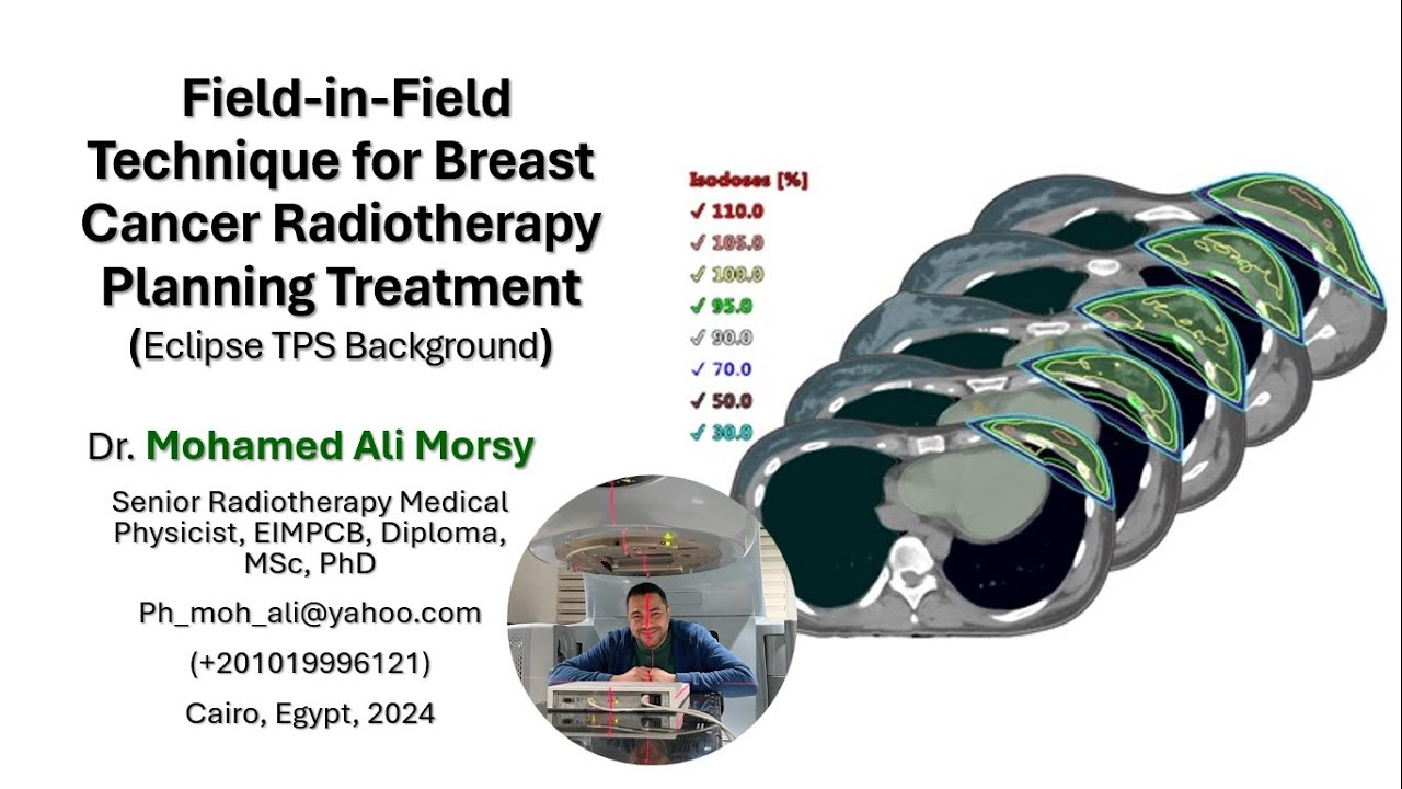 Field in Field Technique for Breast Cancer Radiotherapy Planning