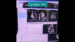 #mriscan #cardic #heart #diagnosticradiology #4chamber#planning.soon full video@avnishradiology #mriscan #cardic #heart #diagnosticradiology #4chamber#planning.soon full video@avnishradiology