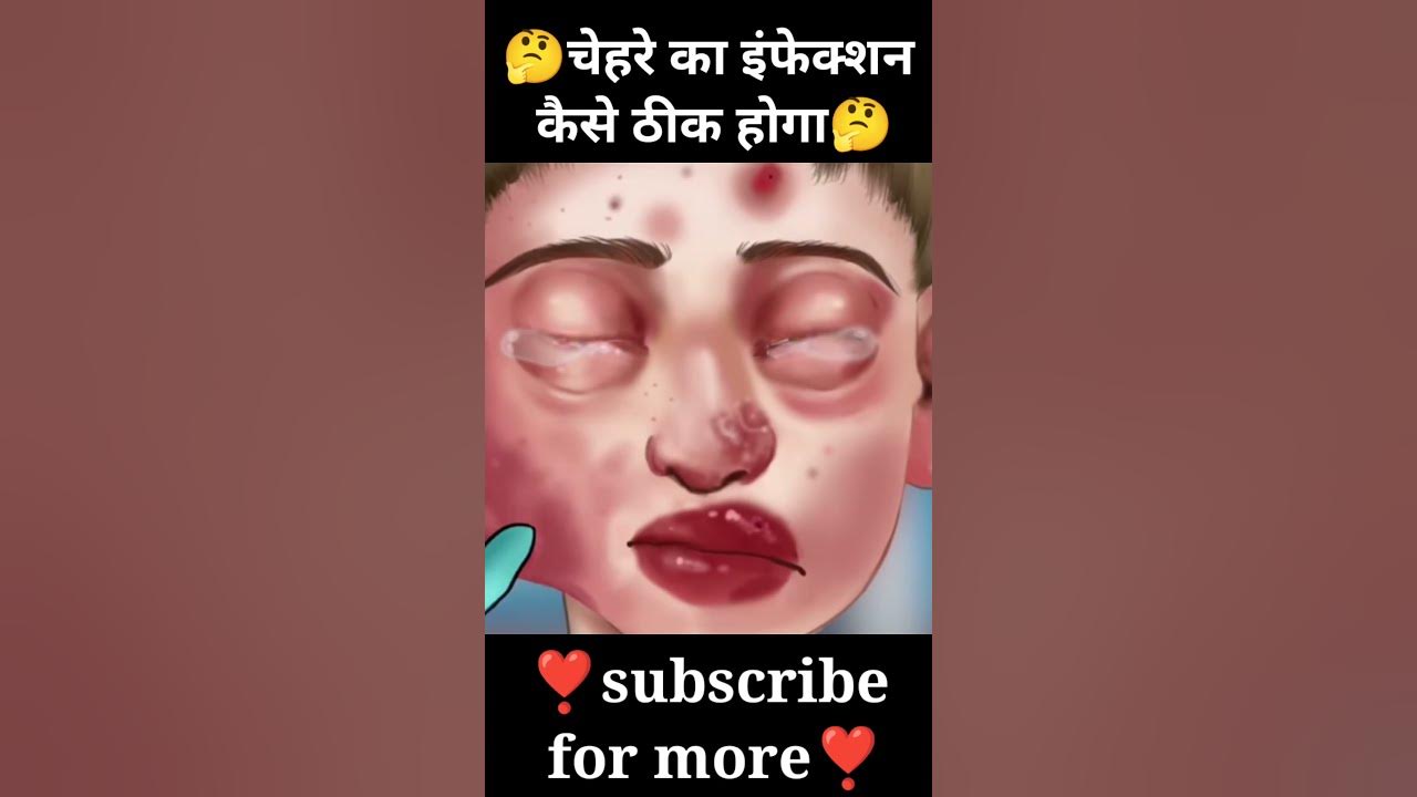 Face ka infection ।। Ye kaya huaa 😱😱।। Kaise thik kare 🤔।। shortfeed 