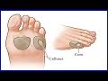 Remove Calluses On Feet  With 10 Effective Home Remedies