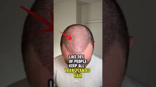 Hair Transplant Timeline: When Does the Growth Really Start?