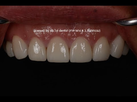 ทำฟันขาวแบบดารา วีเนียร์ คอมโพสิตวีเนียร์ Veneers