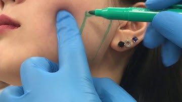 Treating enlarged masseter muscles with Botox by Dr. Shaun Patel