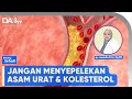 Asam urat dan kolesterol  bincang sehati