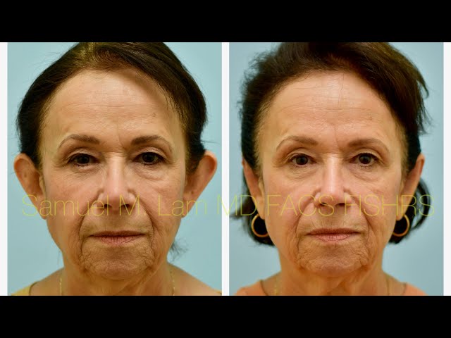 Dallas Otoplasty Testimonial