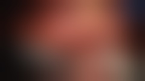 Robotic Partial Nephrectomy for Complex and Hilar Lesions