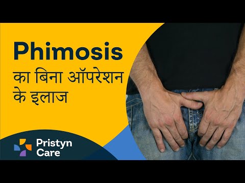 Phimosis का बिना ऑपरेशन के इलाज