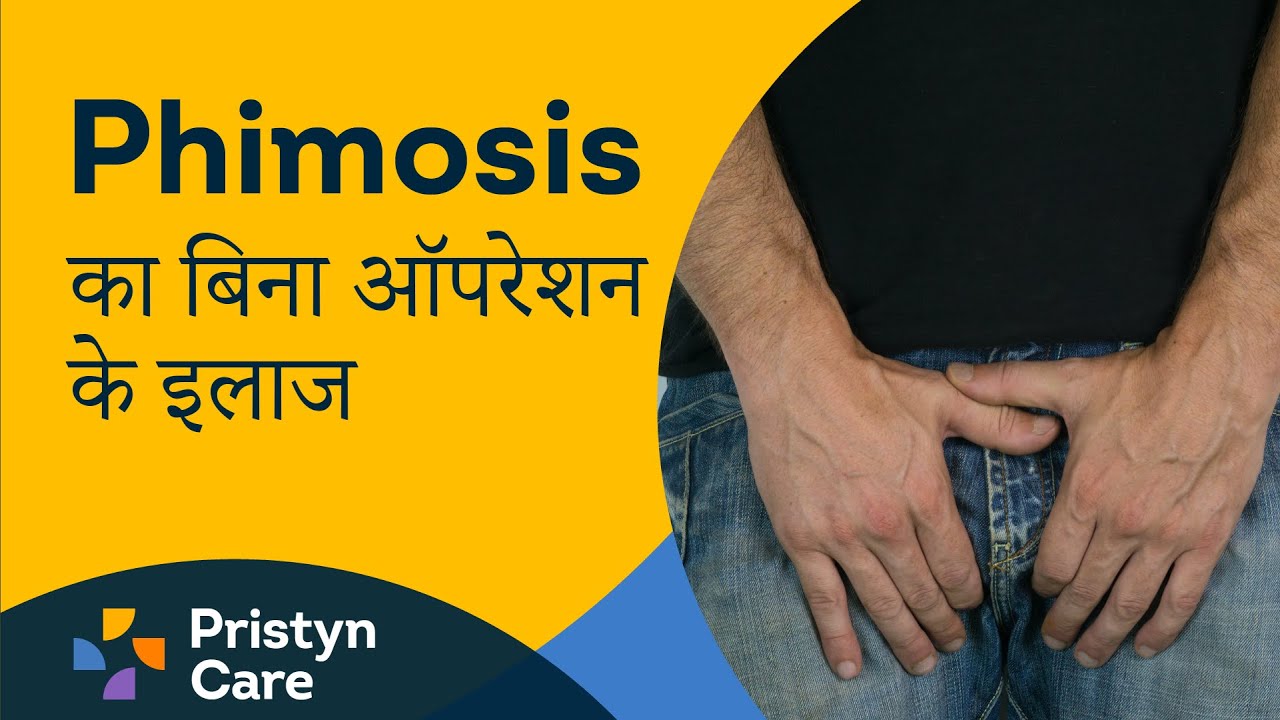 Phimosis का बिना ऑपरेशन के इलाज 