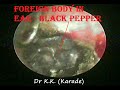 Unexpected Foreign Body in Ear - Black Pepper (Self Medication is Dangerous)