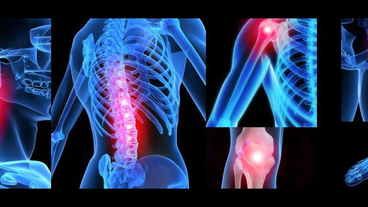 Радикулит артрит артроз. Спондилоартроз болезнь бехтерева. Анкилозирующий спондилоартроз пояснично-крестцового отдела. Ревматоидный артрит шейного отдела. Спиной артрит.