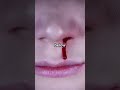 What to Do When You Get a Nosebleed Out of Nowhere