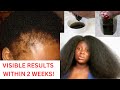 🔥🔥Starting From Scratch Your Hair Will Never Stop Growing! Make This If Your Hair Growth Is Slow!