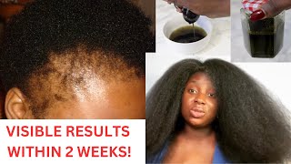 🔥🔥Starting From Scratch Your Hair Will Never Stop Growing! Make This If Your Hair Growth Is Slow!