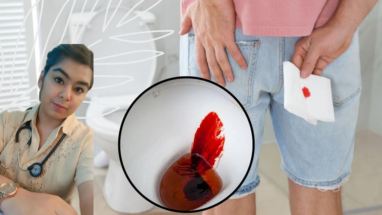 लैट्रिन में खून आना TOP 6 Reasons of Blood in StoolPiles Fissure