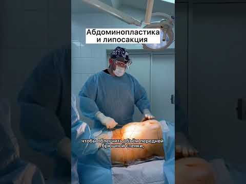 Видео: Как удалить жир с живота хирургическим путем: 11 шагов (с иллюстрациями)