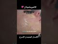 الديرماميلان الجديد