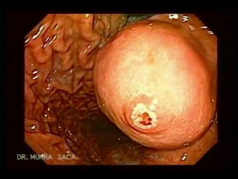 Vídeo: Tumor Intestinal (leiomioma) En Gats