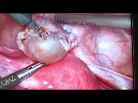 Resseccao por video de cisto parovariano esquerdo/Parovarian left cyst resection by video medicinal genomics