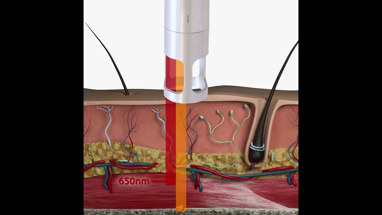 Xtreme Performance - Mectronic Medicale - Theal Therapy - Biological effects