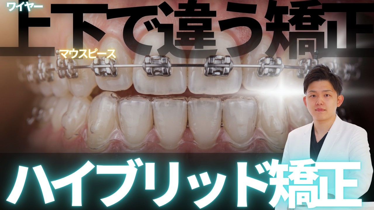 Hybrid Orthodontics] An Orthodontist Explains a Case Using Both
