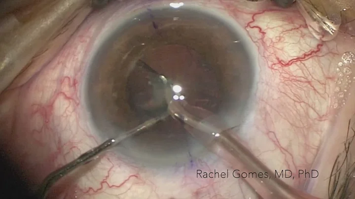 FINEVISION TORIC implantation  by Dra. Rachel Gomes