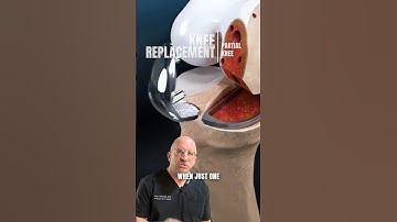 Inside the Operating Room for Partial Knee Replacement