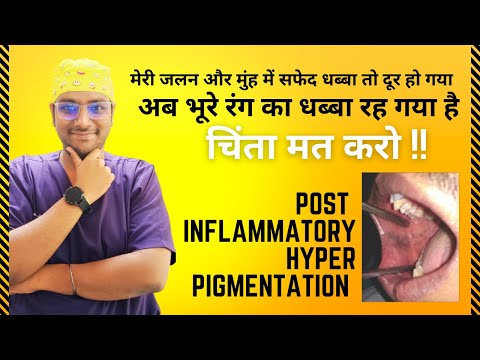 Dr. Rudra | Burning Mouth and White Patches Gone, But Why the Brown Spots? Post-Inflammatory Hype...