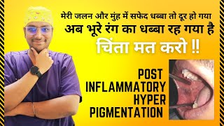 Dr Rudra | मुँह में जलन और सफेद पैच ख़तम पर भूरा निशान क्यों ? Post Inflammatory Hyper Pigmentation screenshot 4