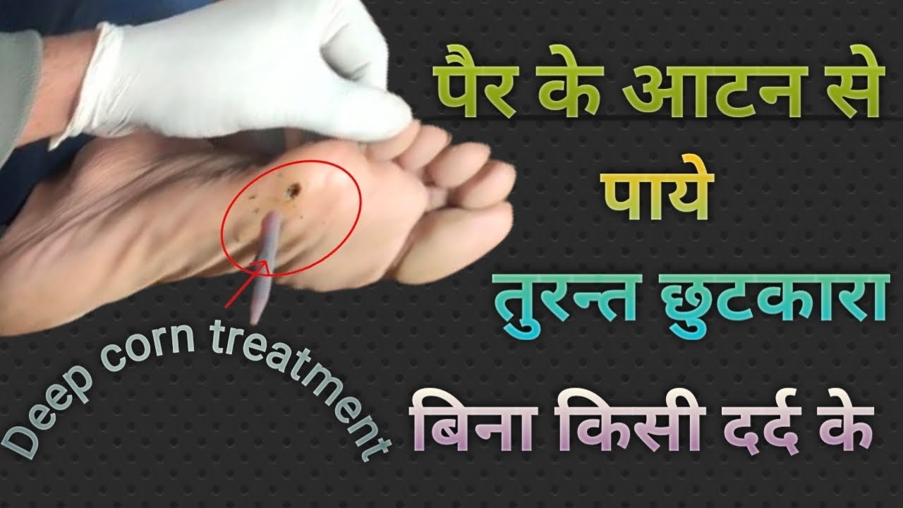 Deep Corn Extraction Deep corn treatment #viral #trending #आयुर्वेद #doctors #agnikarma # ...
