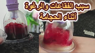 هل الفقاعات والرغوة داخل كاس الحجامة يدل على مرض ما؟