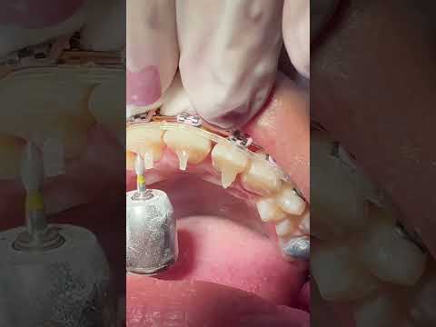 En este caso la lengua está mal posicionada y requiere un recordatorio para ubicarse en el paladar!