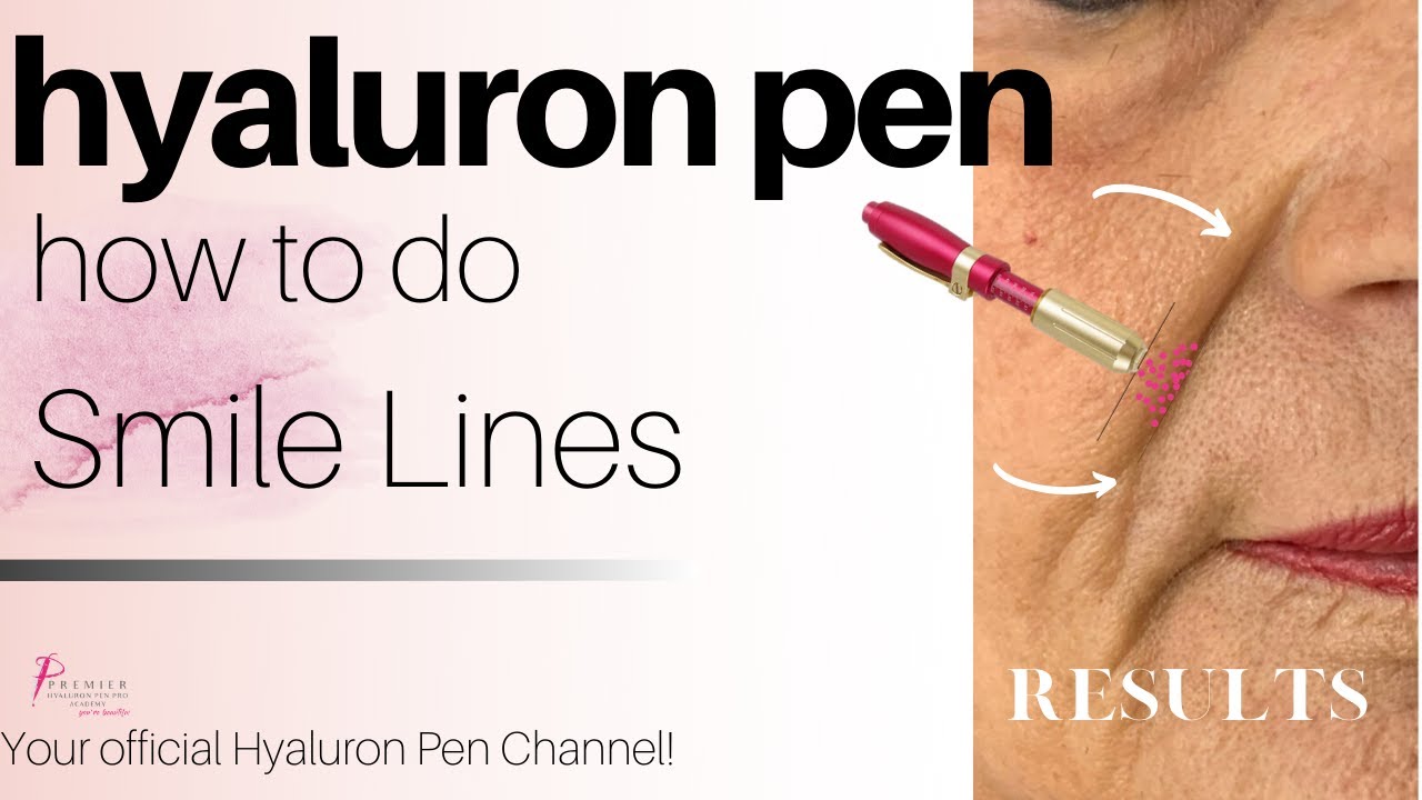 How to do Nasolabial Lines/ Smile Lines / Lines Hyaluron Pen