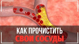 Как Прочистить Свои Сосуды. Атеросклероз - Профилактика, Лечение, Симптомы