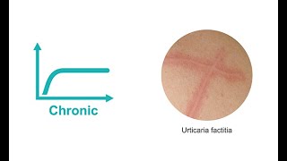 Dermatology 101  Diagnosing a transient rash as urticaria