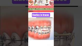How to use Elastics in braces? #braces #dentist