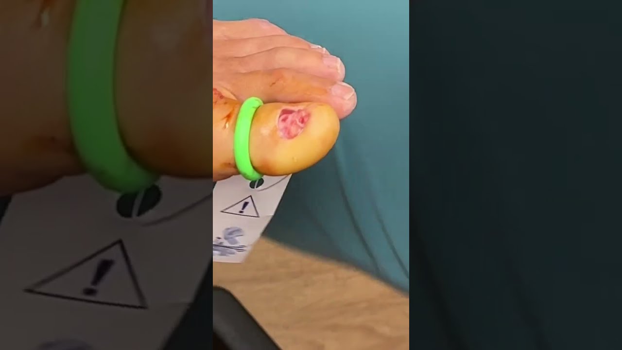 How To Treat Toenail FUNGUS Shorts