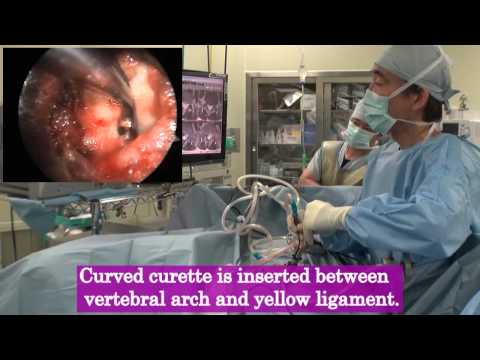 Large herniated lumbar discLarge herniated lumbar discsurgeryLarge herniated lumbar discLarge hernia. 