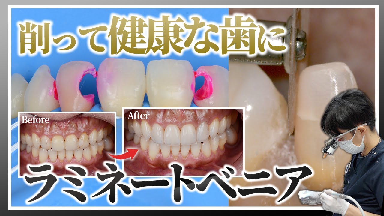 【削ることで健康的な歯に】変色した前歯をラミネートベニア治療で大変身 - YouTube
