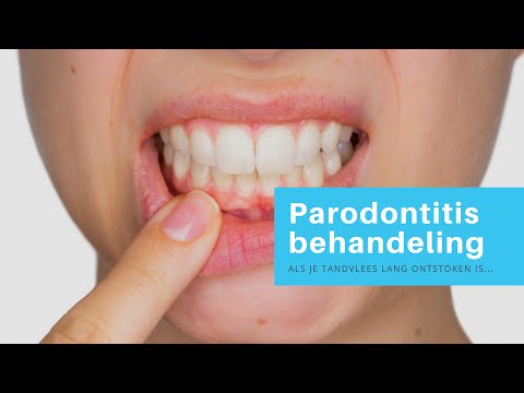 Video: Effectieve manieren om tandvleesflux te behandelen