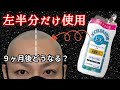 【爆速で髪が伸びる？】ヘアアクセルレーターEXを９ヶ月使用した結果…。