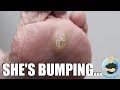 SUPER THICK HARD SKIN BUMP REMOVAL